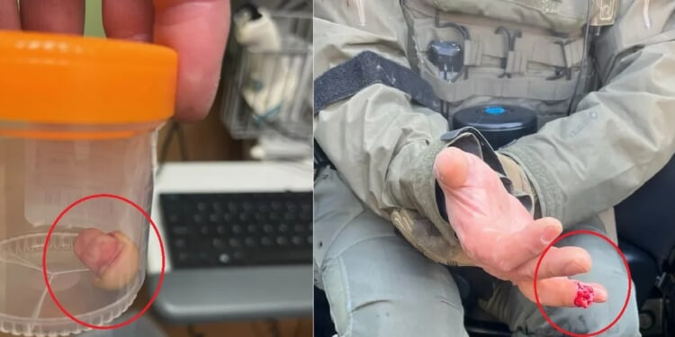 Anti-ICE Rioter Bites Federal Officer’s Finger Off During Minneapolis Chaos