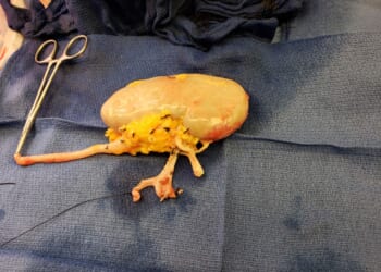 America’s Silent Kidney Crisis | The American Spectator