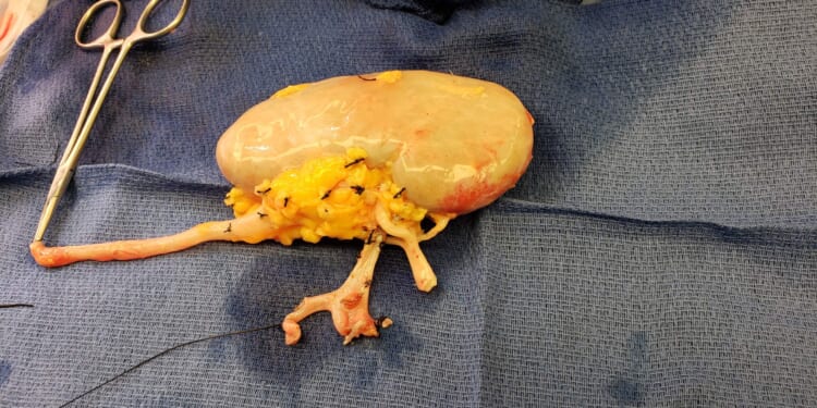 America’s Silent Kidney Crisis | The American Spectator